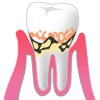 軽度歯周炎のイメージ