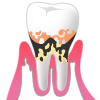 中度歯周炎のイメージ