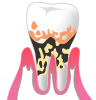 重度歯周炎のイメージ