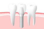 インプラントのイメージ